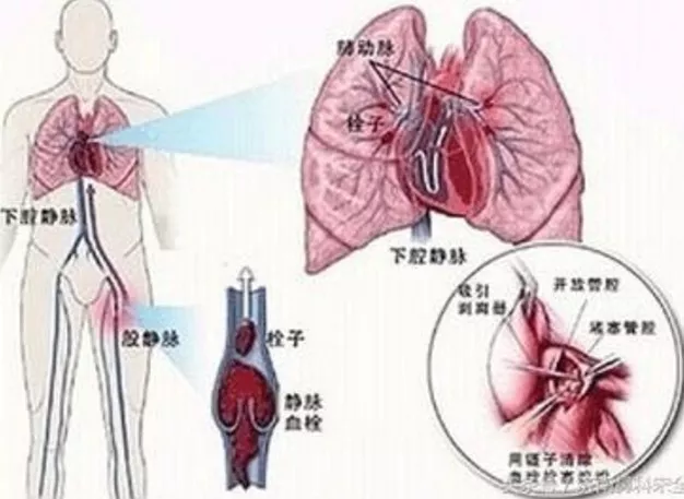 熊孩子往輸液瓶里注臟水 致使奶奶生命垂危